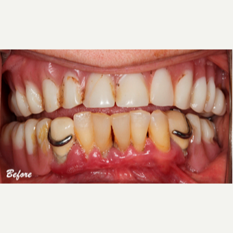 45-54 year old woman treated with Dental Implants before 3577694