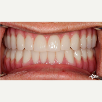 45-54 year old woman treated with Dental Implants after 3577694