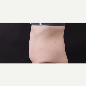 49 year old woman treated with CoolSculpting before 3630242