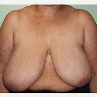 55-64 year old woman treated with Breast Reduction before 2437596