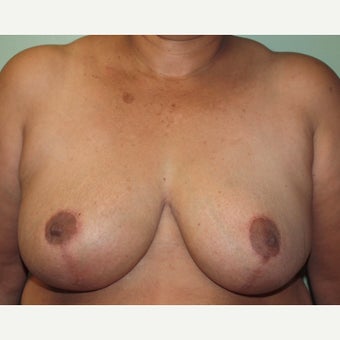 55-64 year old woman treated with Breast Reduction after 2437596
