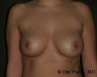 Fat Grafting for Breast Augmentation after 574434