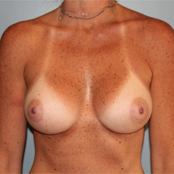 38 year old had Breast Augmentation to add volume and improve sag after 3544375
