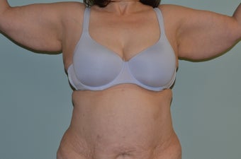 arm lift before 1060308