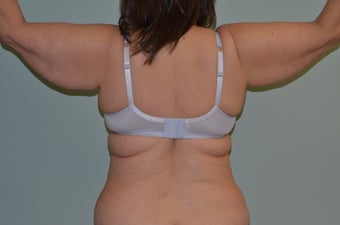 arm lift 1060308