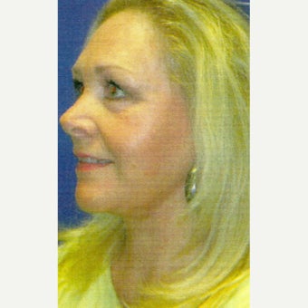 63 year old woman treated with Lower Face Lift including neck lift, liposuction, laser lipolysis 1803581