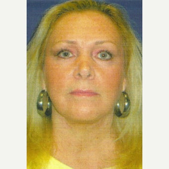 63 year old woman treated with Lower Face Lift including neck lift, liposuction, laser lipolysis after 1803581