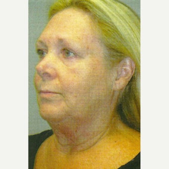 63 year old woman treated with Lower Face Lift including neck lift, liposuction, laser lipolysis 1803581