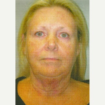 63 year old woman treated with Lower Face Lift including neck lift, liposuction, laser lipolysis before 1803581