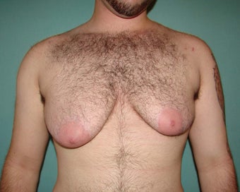 FTM "Top Surgery" for chest masculinization before 867217