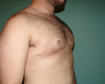 FTM "Top Surgery" for chest masculinization 867217