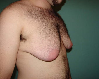 FTM "Top Surgery" for chest masculinization 867217