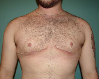 FTM "Top Surgery" for chest masculinization after 867217