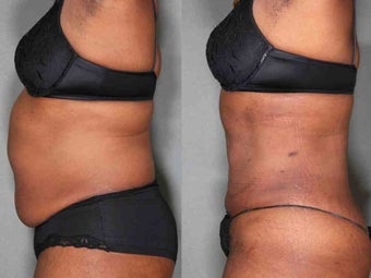 49 Year Old Female Liposuction after 1046333