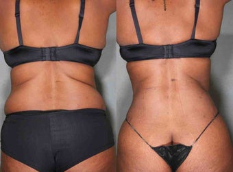 49 Year Old Female Liposuction before 1046333