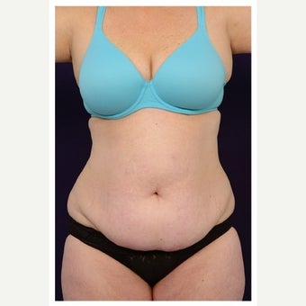 45-54 year old woman treated with Mini Tummy Tuck before 1567371