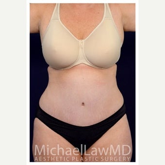 45-54 year old woman treated with Mini Tummy Tuck after 1567371