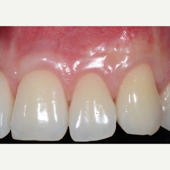 25-34 year old man with multiple gingival recessions treated with root coverage procedures after 1572209