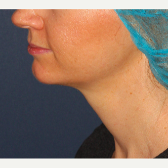 25-34 year old woman treated with ThermiTight after 3138839
