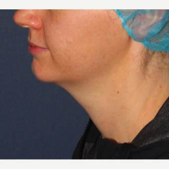 25-34 year old woman treated with ThermiTight before 3138839