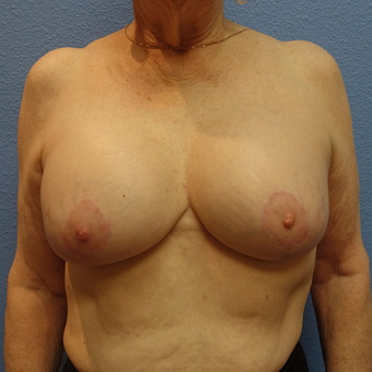 65-74 year old woman treated with Breast Lift with Implants after 3254922