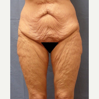 45-54 year old woman treated with Body Lift before 3630257