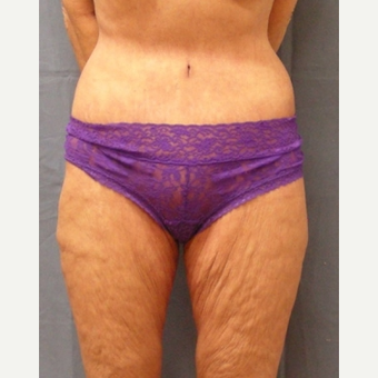 45-54 year old woman treated with Body Lift after 3630257