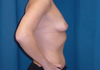 Breast Lift 1161332