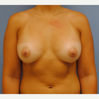 23 year old woman treated with Breast Augmentation using 375 cc silicone mod profile plus after 3208107