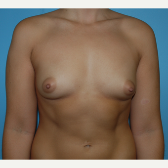 23 year old woman treated with Breast Augmentation using 375 cc silicone mod profile plus before 3208107