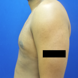 Male Breast Reduction after 3565818