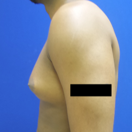 Male Breast Reduction before 3565818