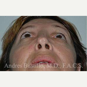 40 year old woman treated with Revision Rhinoplasty before 3460673