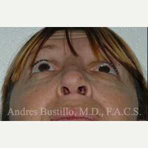 40 year old woman treated with Revision Rhinoplasty after 3460673
