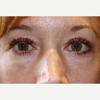 35-44 year old woman treated with Drop-and-Lift after 3171728