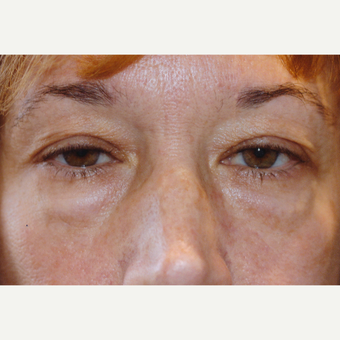 35-44 year old woman treated with Drop-and-Lift before 3171728