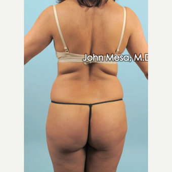 35-44 year old woman treated with Liposuction of flanks, back and sacrum before 3659818