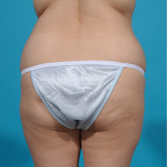 25-34 year old woman treated with Brazilian Butt Lift before 3282714