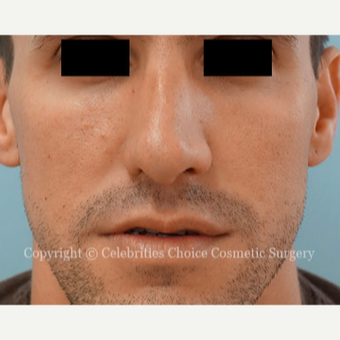 25-34 year old man treated with Rhinoplasty after 3337689