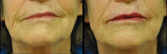 Juvederm and Belotero for Lip Augmentation before 981995