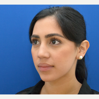 Buccal Fat Removal with Chin Liposculpting after 2791273