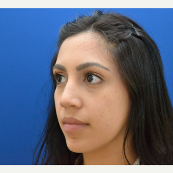 Buccal Fat Removal with Chin Liposculpting before 2791273