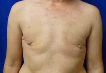 Bilateral Nipple Sparing Mastectomies via ILateral Incision and Delayed Reconstruction with Expanders and Alloderm before 1263164
