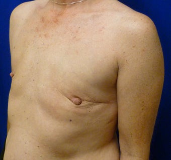 Bilateral Nipple Sparing Mastectomies via ILateral Incision and Delayed Reconstruction with Expanders and Alloderm 1263164