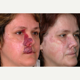 35-44 year old woman treated with Birthmark Removal before 3415204