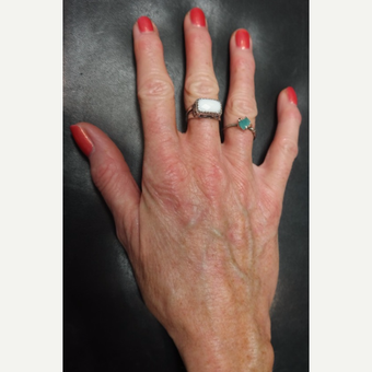 55-64 year old woman treated with Radiesse for Hand Volumization before 3297884