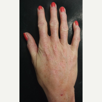 55-64 year old woman treated with Radiesse for Hand Volumization after 3297884