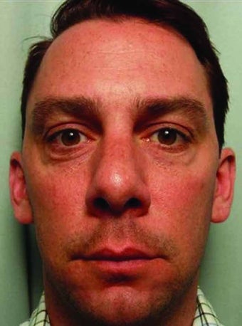 Botox combined with Juvederm Injections before 343315