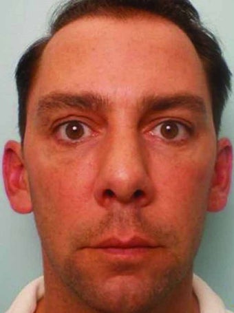 Botox combined with Juvederm Injections after 343315