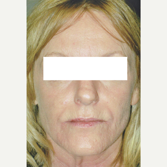 52 year old woman treated with Fraxel 1927, Botox, Fillers after 3055746
